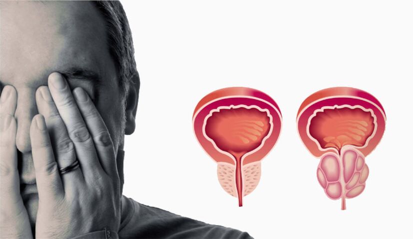 Prostatitis crónica