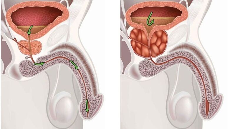 Glándula prostática sana e inflamada con prostatitis.