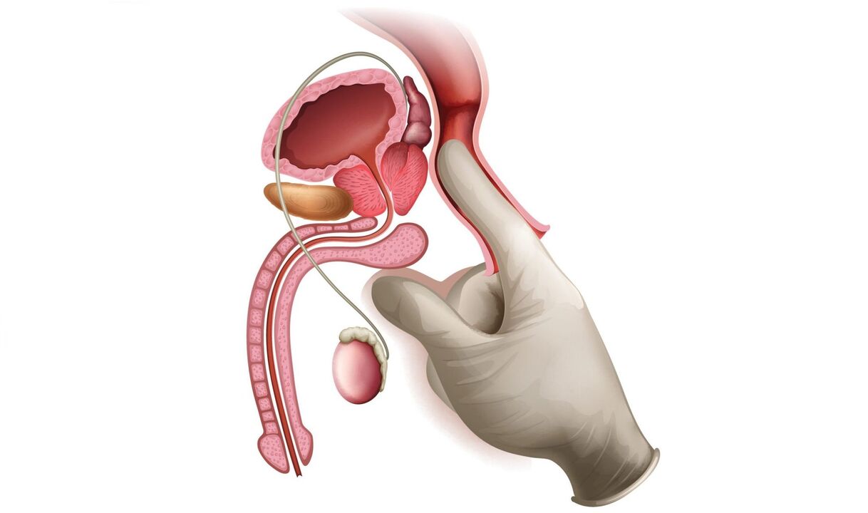 masaje prostático para la prostatitis