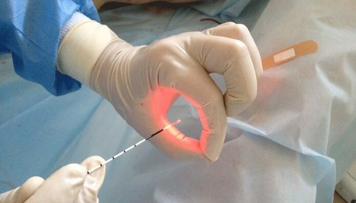 tratamiento con láser para la prostatitis
